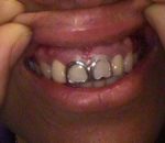 case2bf